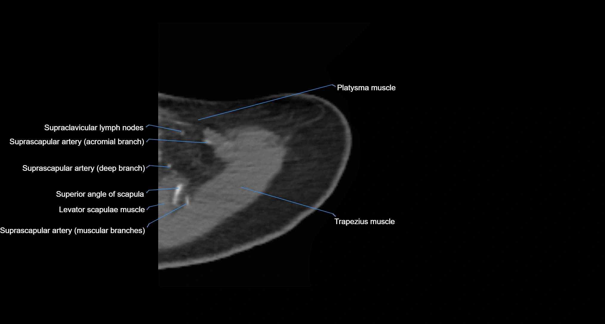 CT Shoulder axial cross sectional anatomy labelled radiology image -00010.webp